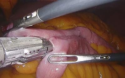 Surgical Treatment of Obesity. Special Mention to Roux-en-Y Gastric Bypass and Vertical Gastrectomy